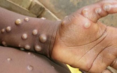 Prefeitura de Araguaína define plano de contenção à Varíola dos Macacos