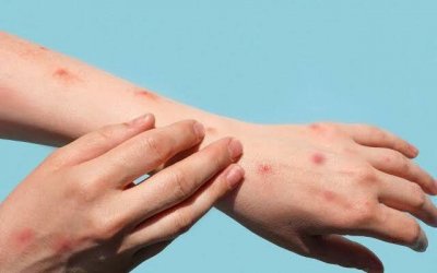 Tocantins confirma 1º caso de varíola dos macacos