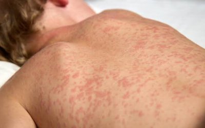 Sarampo se espalha no Tocantins e acende sinal de alerta: 20 casos já foram registrados