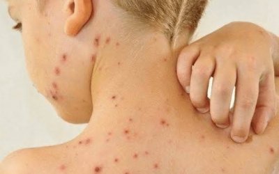 Mais quatro casos de sarampo são confirmados no Tocantins; pacientes não estavam vacinados