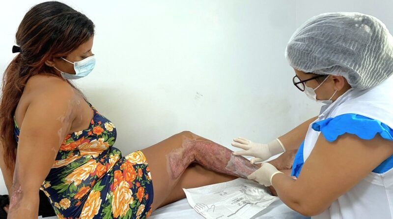 Vítima de queimadura tem saúde recuperada em tratamento no HRA