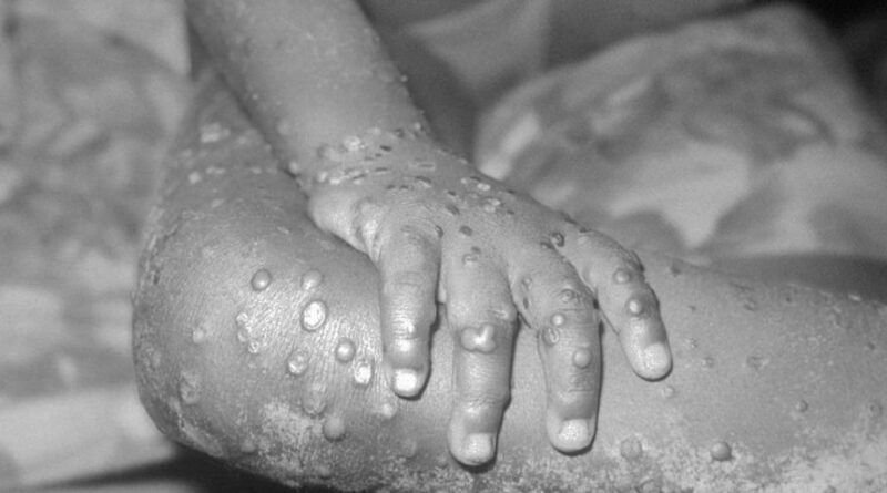 Estado do Tocantins tem 6 casos suspeitos de Monkeypox