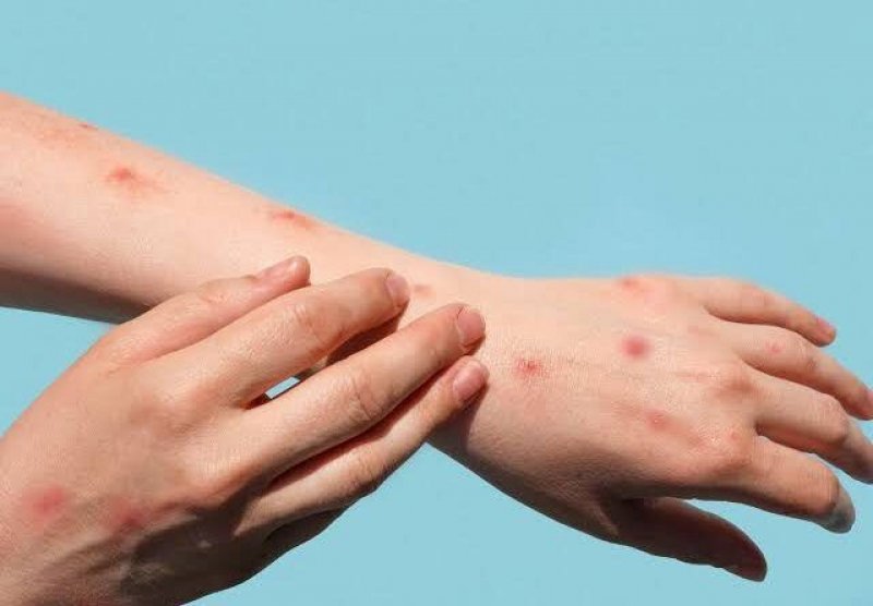 Estado define plano de contingência para a Varíola dos Macacos