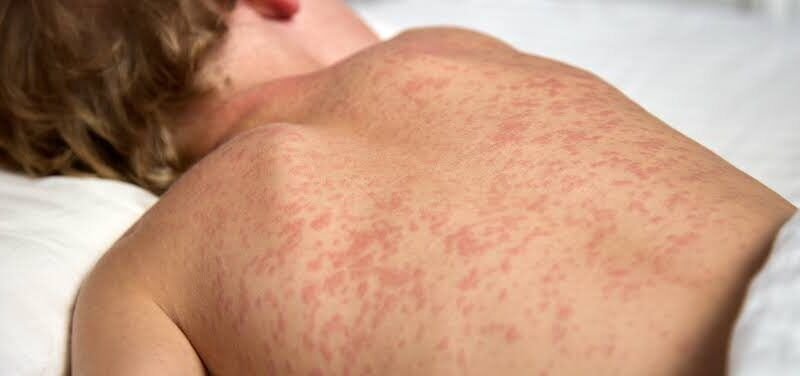 Sarampo se espalha no Tocantins e acende sinal de alerta: 20 casos já foram registrados