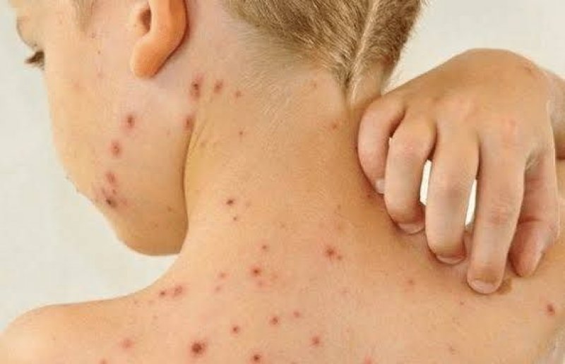 Mais quatro casos de sarampo são confirmados no Tocantins; pacientes não estavam vacinados